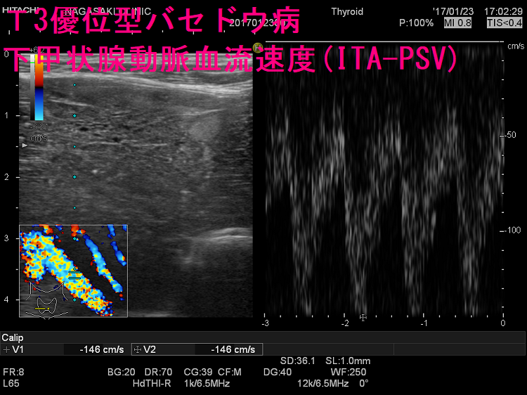 Ｔ3優位型バセドウ病 超音波（エコー）画像 ITA-PSV