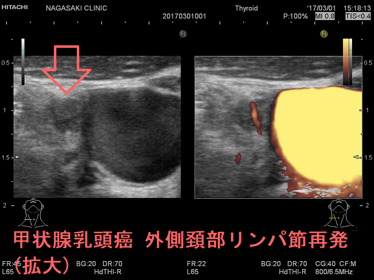 甲状腺乳頭癌 外側頚部リンパ節再発 超音波(エコー)画像 (拡大)