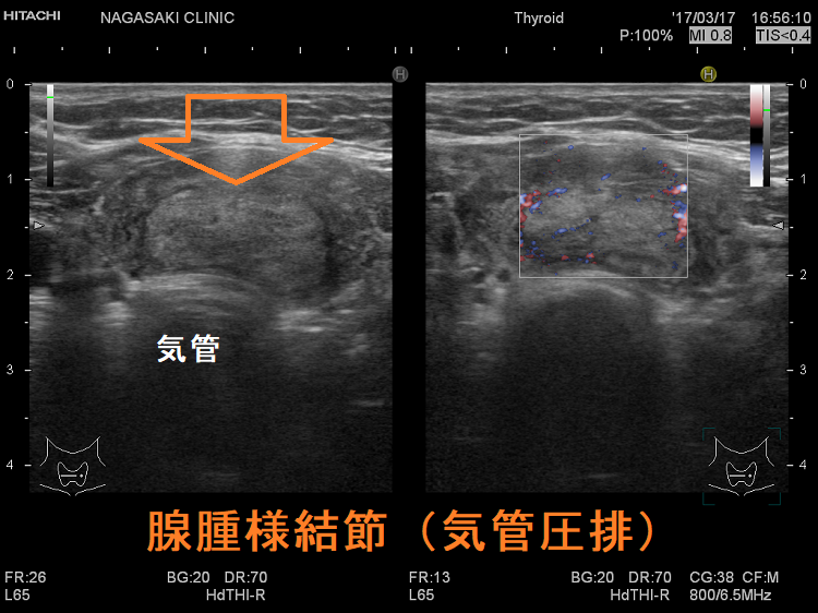 腺腫様結節（気管圧排）　超音波(エコー)画像
