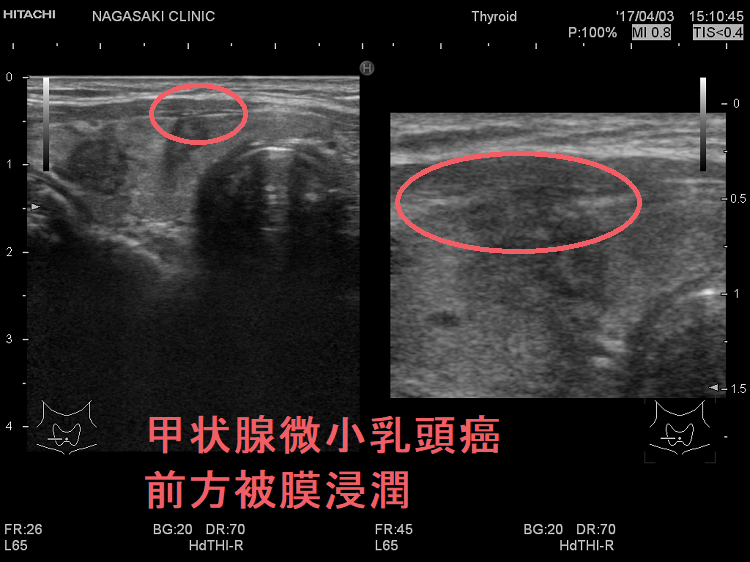 甲状腺微小乳頭癌 前方被膜浸潤 超音波(エコー)画像