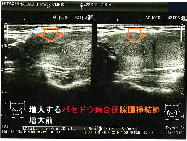 増大するバセドウ病合併腺腫様結節 増大前1