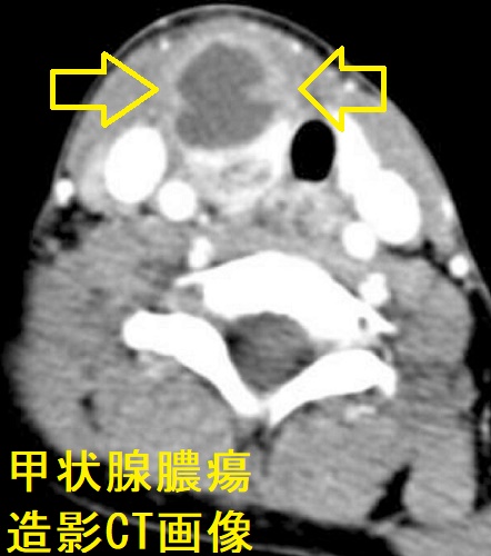 甲状腺膿瘍　造影CT画像