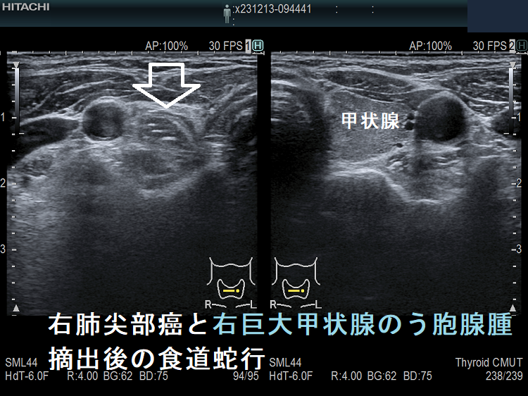 右肺尖部癌と右巨大甲状腺のう胞腺腫で右半葉摘出後の食道蛇行(水平断)
