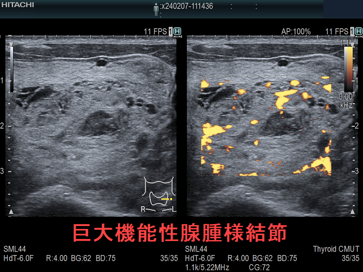 多結節性甲状腺腫の診断
