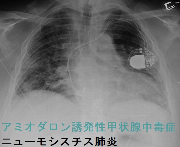 アミオダロン誘発性甲状腺中毒症 ニューモシスチス肺炎