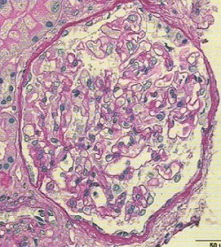 腎アミロイドーシスPAS染色