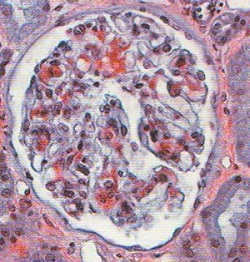 腎アミロイドーシス コンゴーレッド染色