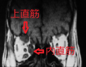 外眼筋炎 MRI画像