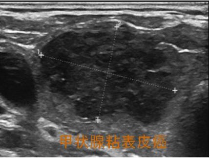 甲状腺粘表皮癌 超音波エコー画像