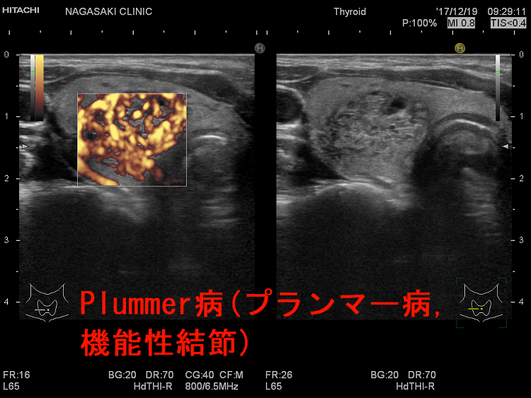 Plummer 病（プランマー病） 機能性結節（腺腫様結節） 超音波画像