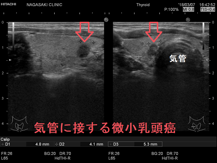 気管に接する微小乳頭癌 超音波(エコー)画像