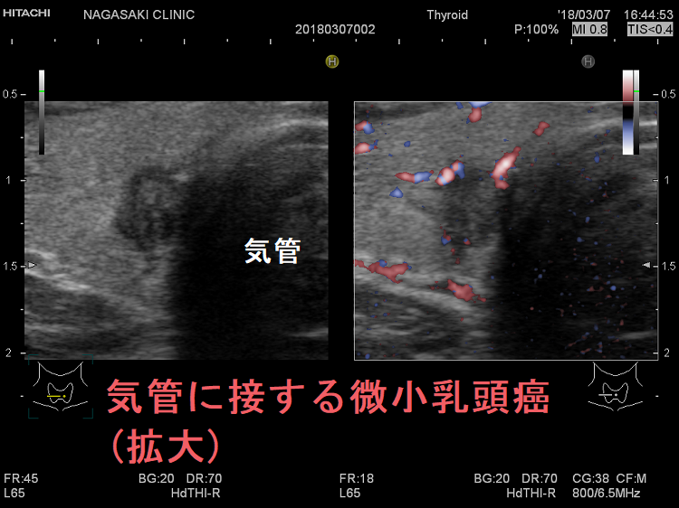 気管に接する微小乳頭癌 超音波(エコー)画像(拡大)