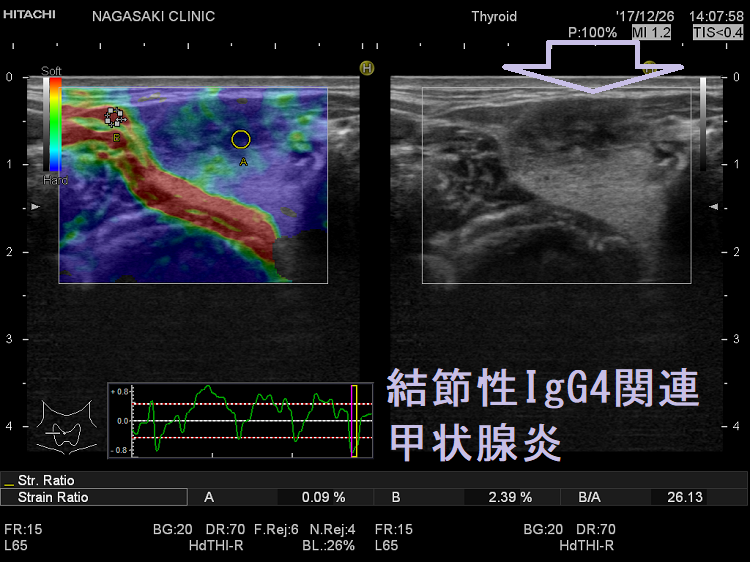 結節性IgG4関連甲状腺炎 超音波(エコー)画像