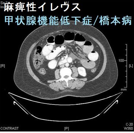 橋本脳症と偽性腸閉塞症（麻痺性イレウス）をおこした甲状腺機能低下症 橋本病患者　腹部単純CT写真