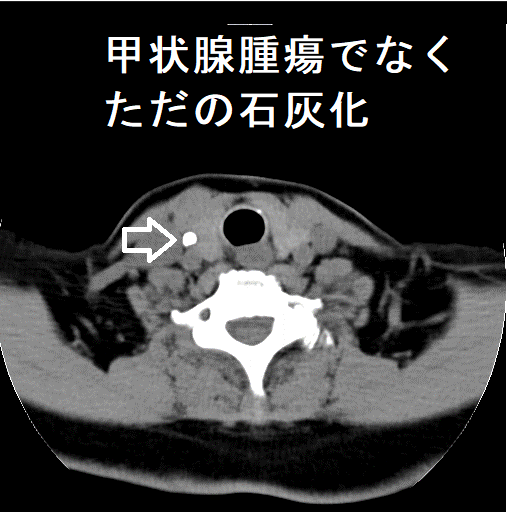 甲状腺腫瘍でなく、ただの石灰化　単純CT画像