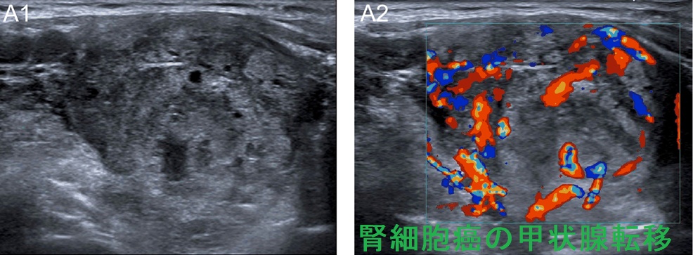 腎細胞癌の甲状腺転移