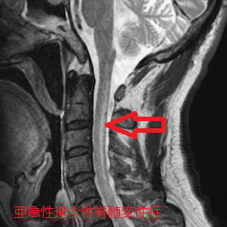 亜急性連合性脊髄変性症　MRI画像