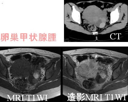 卵巣甲状腺腫 CT画像 MRI画像