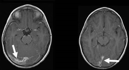 脳静脈洞血栓 MRI画像