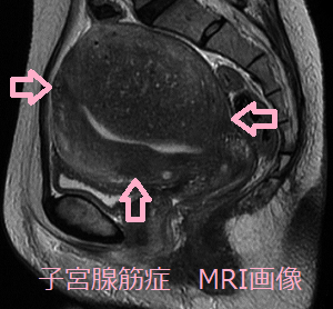 子宮腺筋症 MRI画像