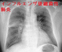 インフルエンザ後細菌性肺炎 インフルエンザ後細菌性肺炎