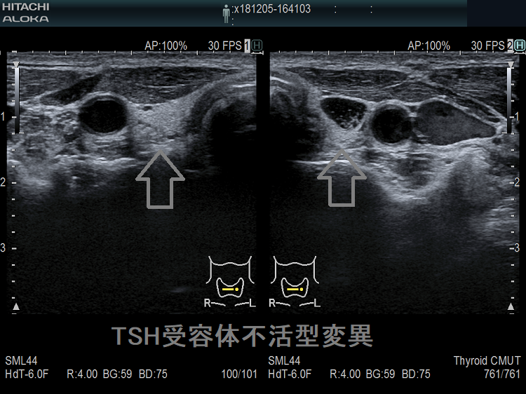 TSH受容体不活性型変異 超音波(エコー)画像
