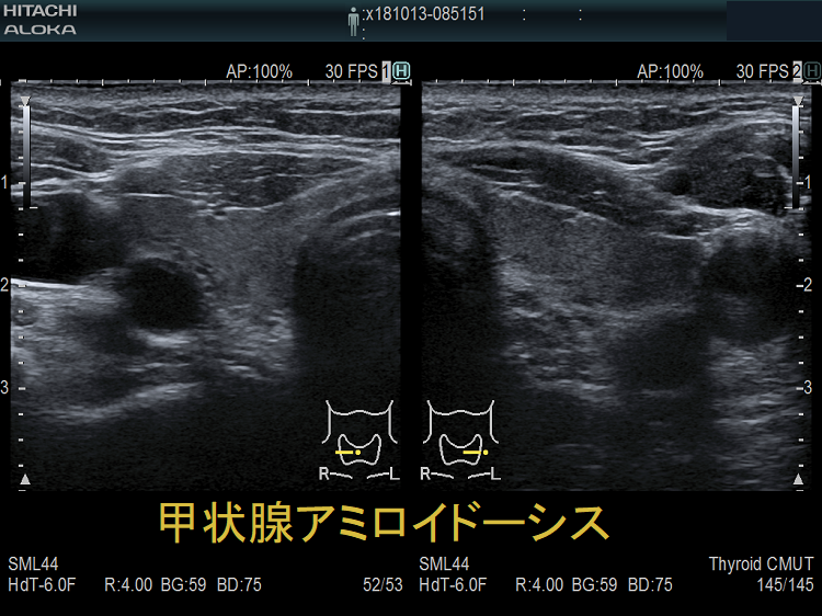 甲状腺アミロイドーシス 超音波(エコー)画像
