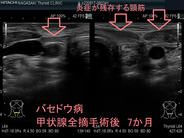 バセドウ病 甲状腺全摘手術後 7か月 超音波(エコー)画像