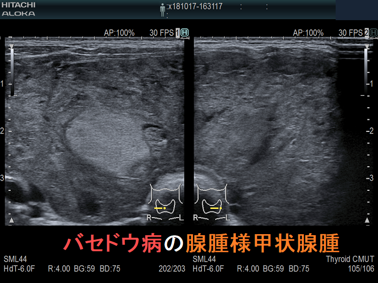 バセドウ病の腺腫様甲状腺腫 超音波(エコー)画像