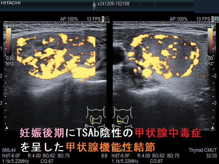 妊娠後期にTSAb陰性の甲状腺中毒症を呈した甲状腺機能性結節1