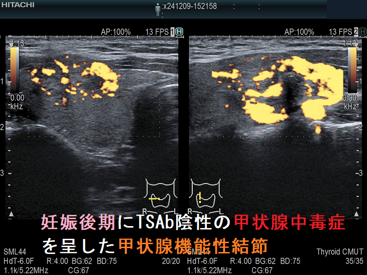 妊娠後期にTSAb陰性の甲状腺中毒症を呈した甲状腺機能性結節2