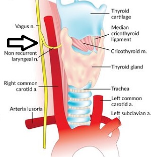右側非反回下喉頭神経(NRILN)
