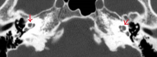 ペンドレッド症候群 前庭水管 CT画像