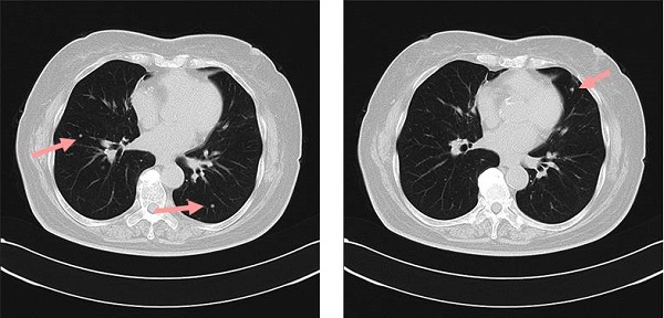 甲状腺乳頭癌　肺転移　CT画像