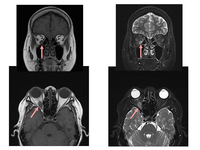 アイソトープ治療後バセドウ病眼症 MRI画像