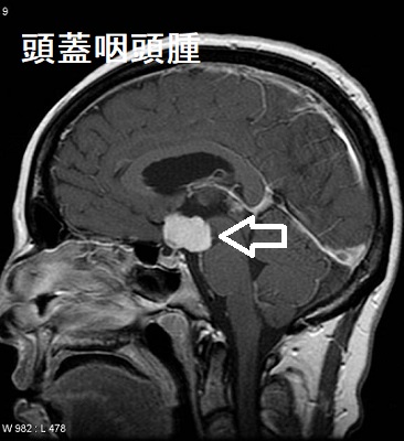 頭蓋咽頭腫 MRI画像