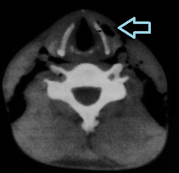 頸部皮下気腫　CT画像