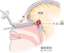 経蝶形骨洞的下垂体腫瘍摘出術(Hardy法)