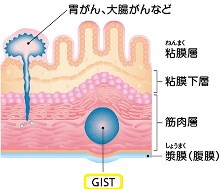GIST（消化管間質腫瘍）