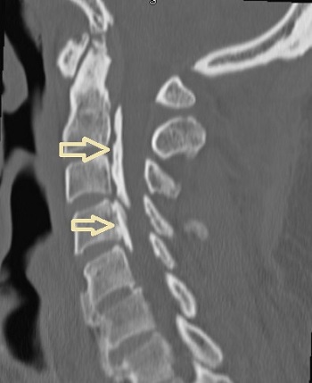 頚椎後縦靱帯骨化症 CT画像
