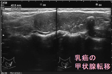 乳癌の甲状腺転移　超音波(エコー)画像