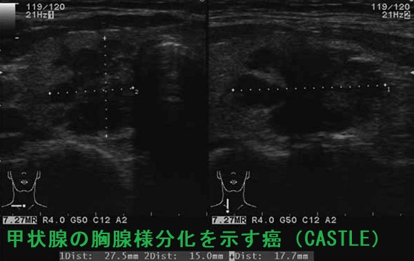 甲状腺の胸腺様分化を示す癌（CASTLE）超音波(エコー)画像
