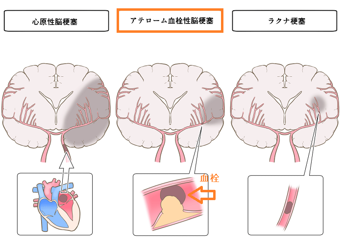 甲状腺機能低下症 バセドウ病と脳梗塞 甲状腺専門医 橋本病 動脈硬化 長崎甲状腺クリニック大阪