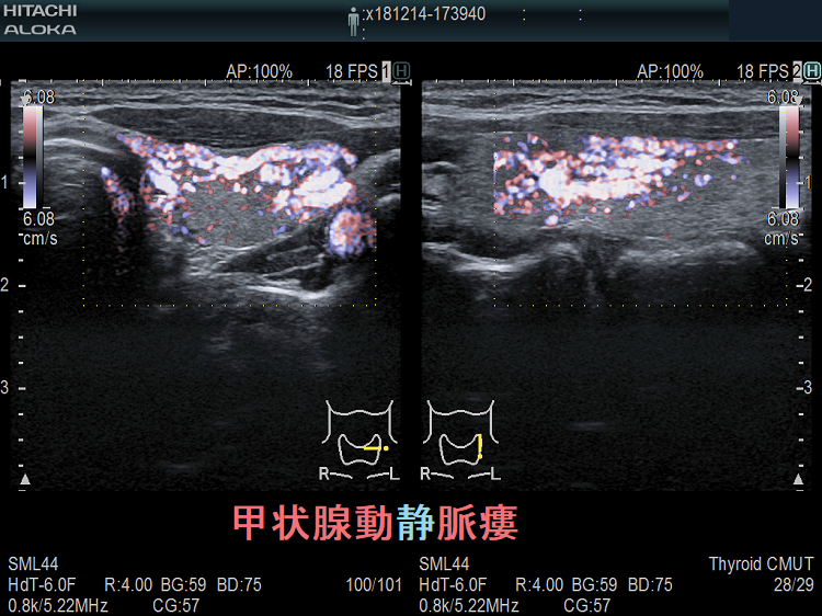 甲状腺動静脈瘻 超音波(エコー)画像 ドプラーモード