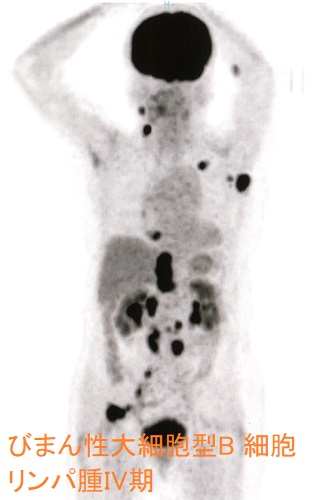 びまん性大細胞型B 細胞リンパ腫IV期