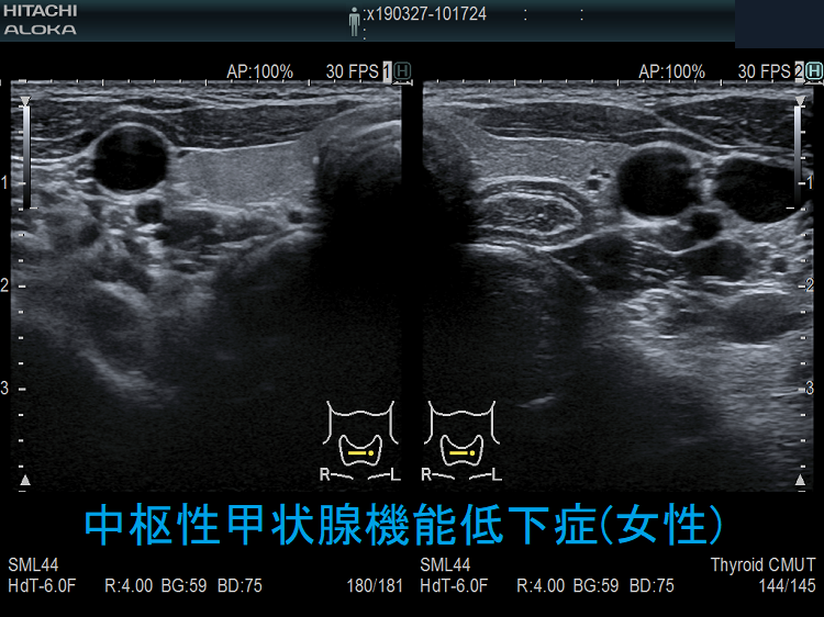 中枢性甲状腺機能低下症(女性)　超音波(エコー)画像