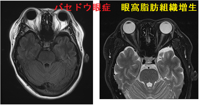 バセドウ眼症　眼窩脂肪組織増生 MRI画像