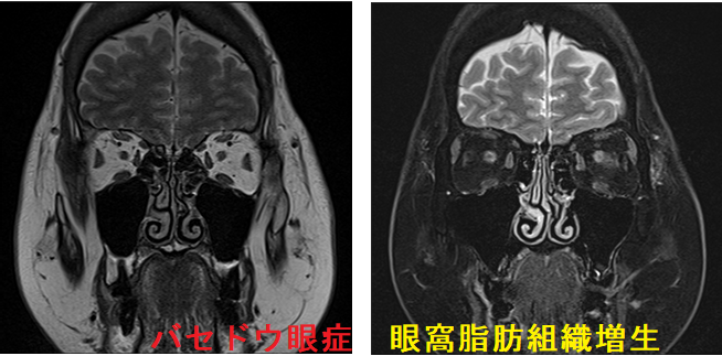 バセドウ眼症　眼窩脂肪組織増生 MRI画像2