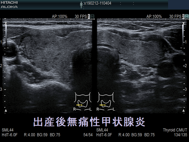 出産後無痛性甲状腺炎 超音波(エコー)画像