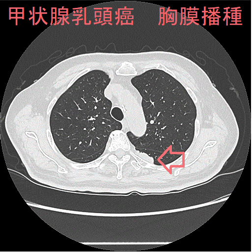 甲状腺乳頭癌　胸膜播種 CT画像1